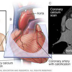 Coronary Calcium