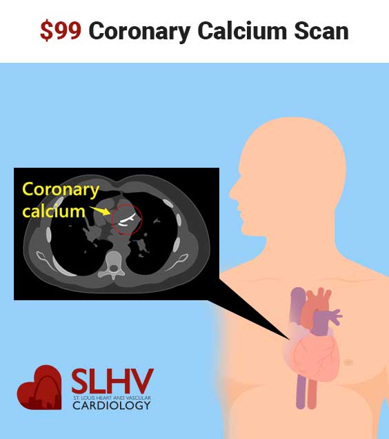 $99 Coronary Calcium Scan